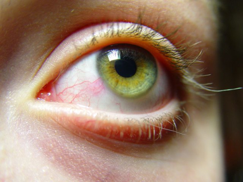 慢性肾炎眼睛肿的照片图片